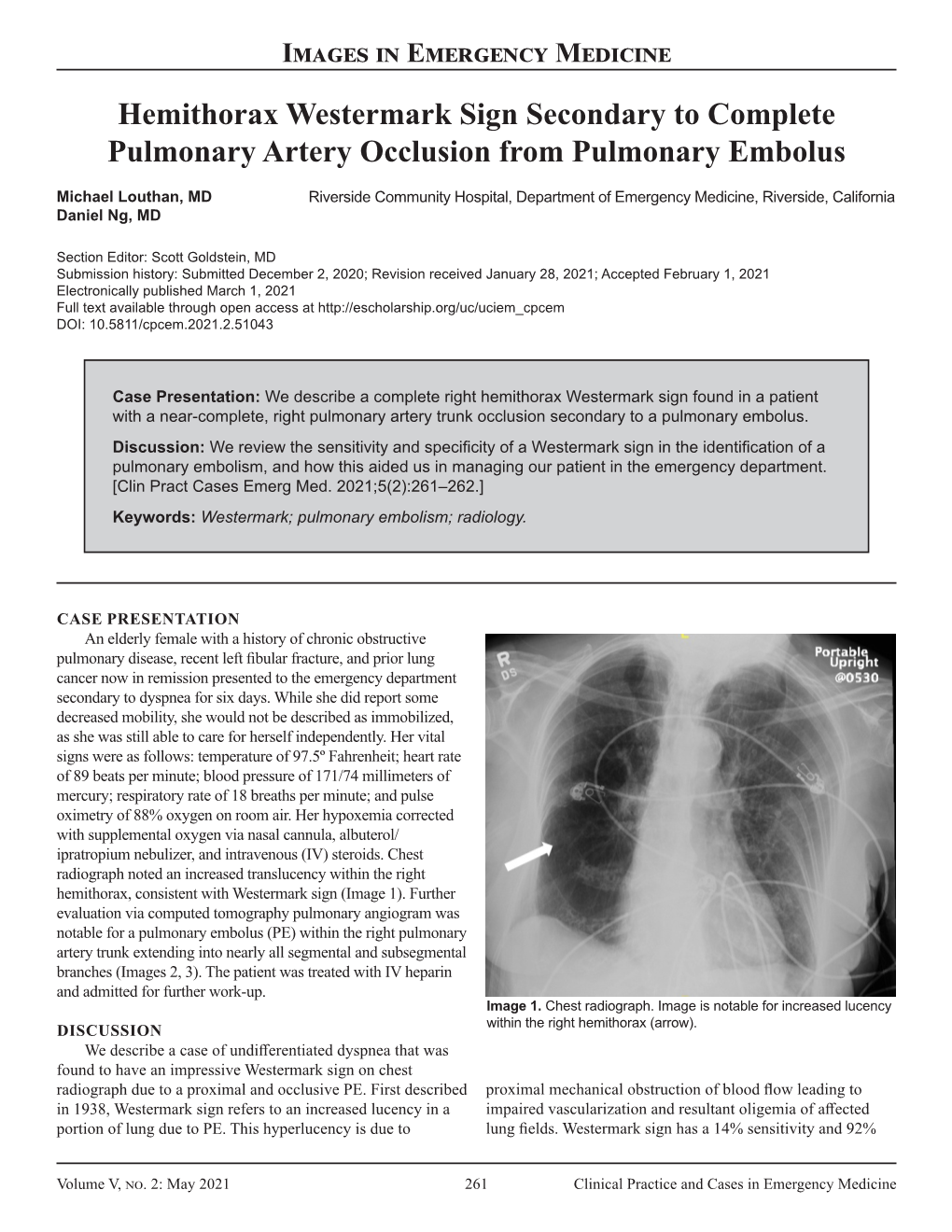 Hemithorax Westermark Sign Secondary to Complete Pulmonary Artery Occlusion from Pulmonary Embolus