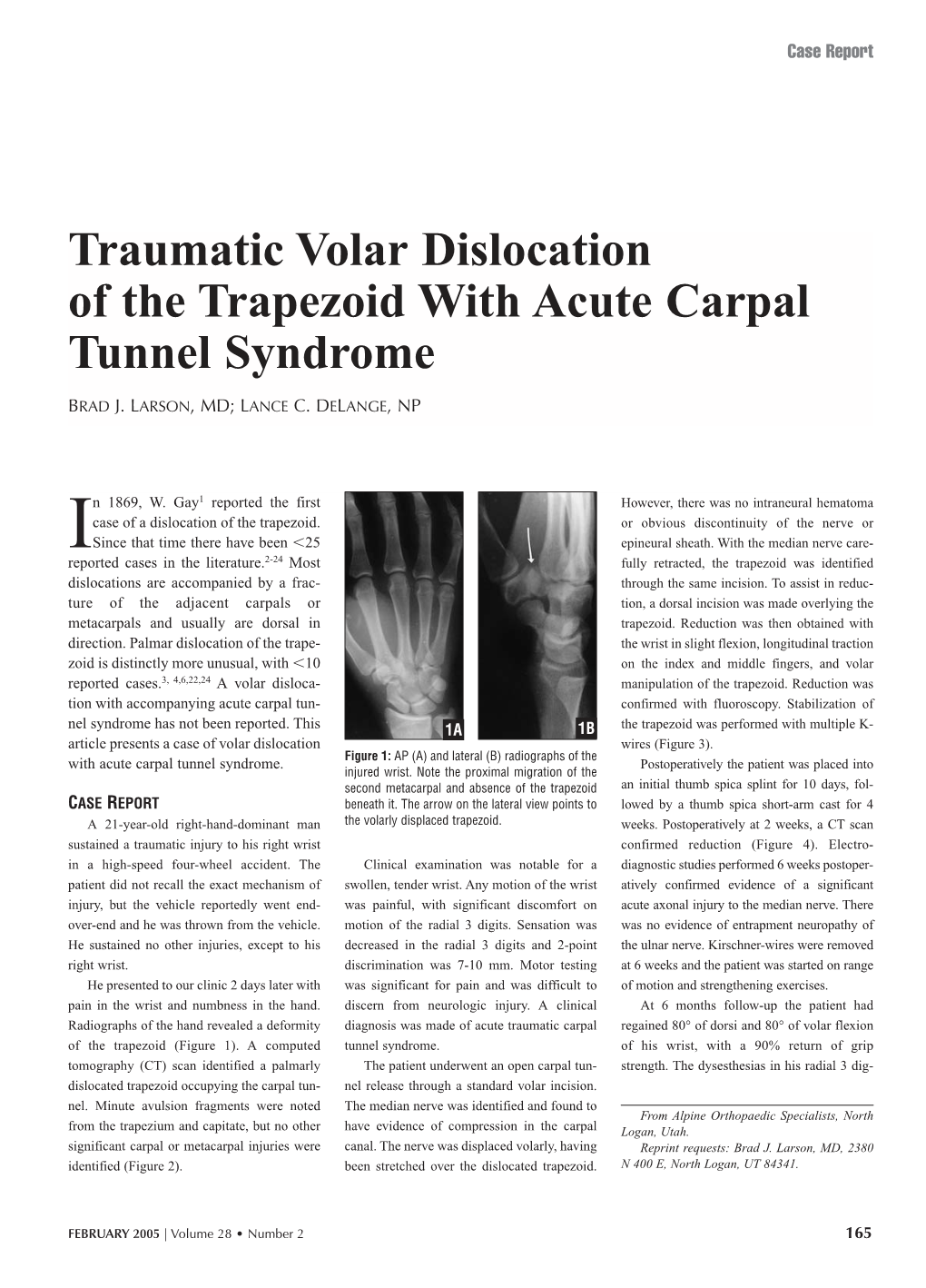 Traumatic Volar Dislocation of the Trapezoid with Acute Carpal Tunnel Syndrome