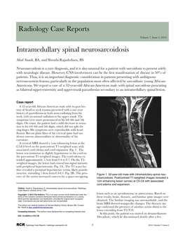 Intramedullary Spinal Neurosarcoidosis