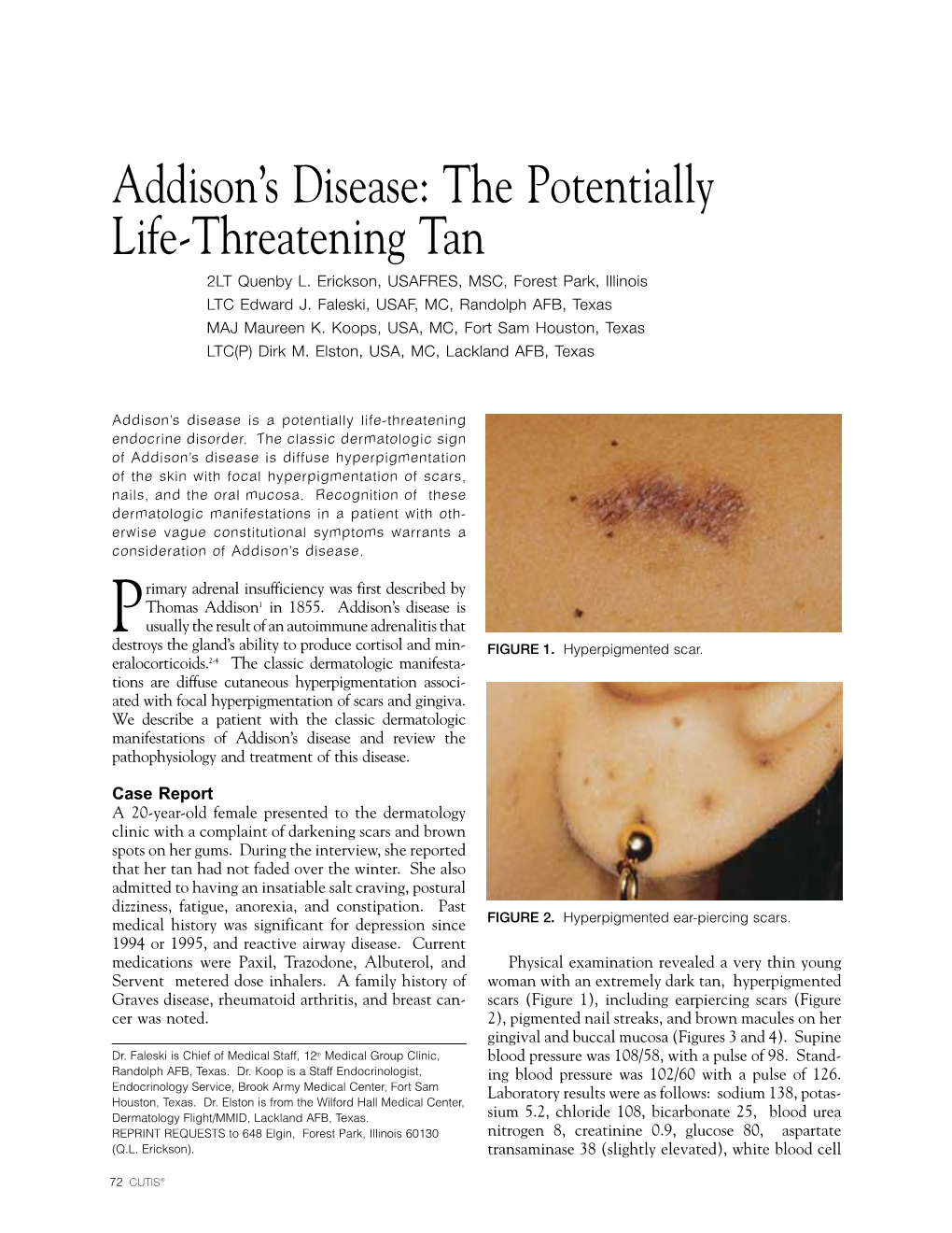 Addison's Disease