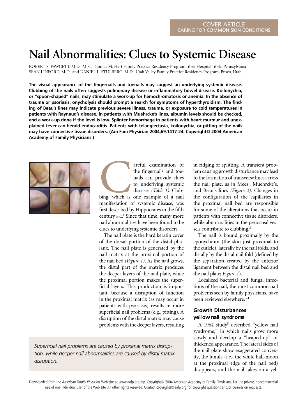 Nail Abnormalities: Clues to Systemic Disease ROBERT S