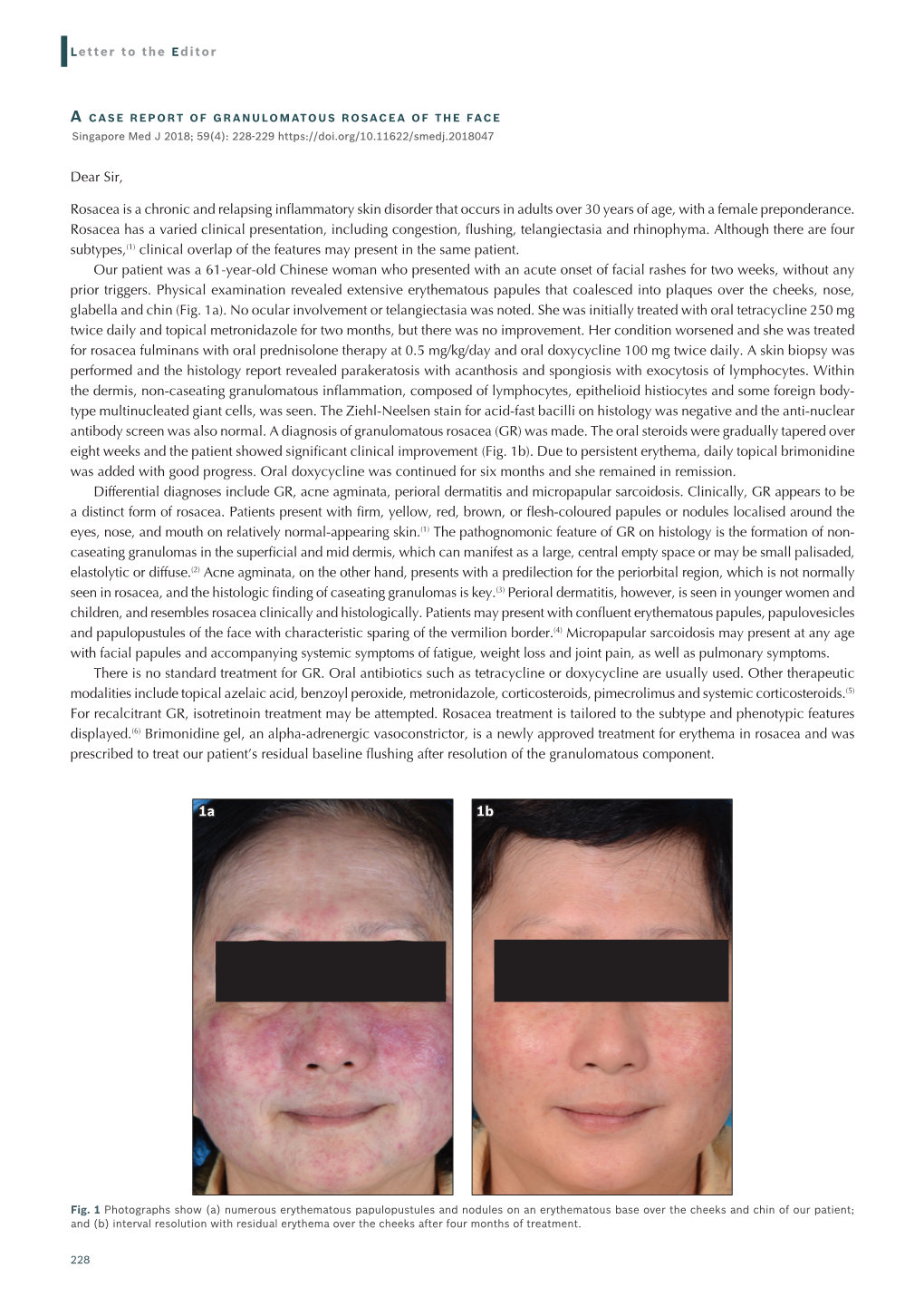 Dear Sir, Rosacea Is a Chronic and Relapsing Inflammatory Skin