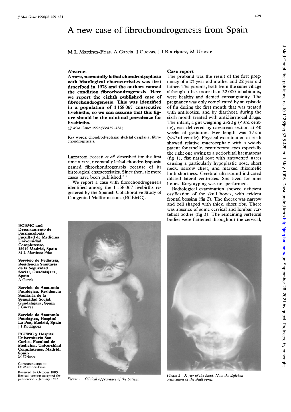 A New Case of Fibrochondrogenesis from Spain J Med Genet: First Published As 10.1136/Jmg.33.5.429 on 1 May 1996