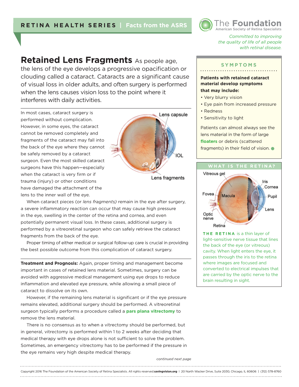 Retained Lens Fragments As People Age, SYMPTOMS the Lens of the Eye Develops a Progressive Opacification Or Clouding Called a Cataract