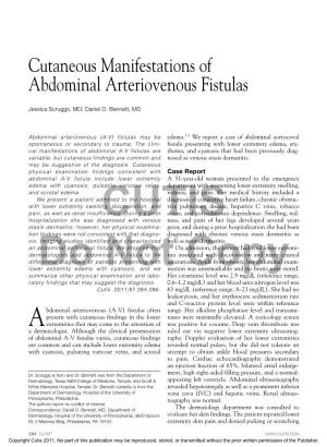 Cutaneous Manifestations of Abdominal Arteriovenous Fistulas