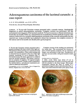 Adenosquamous Carcinoma of the Lacrimal Caruncle: a Case Report