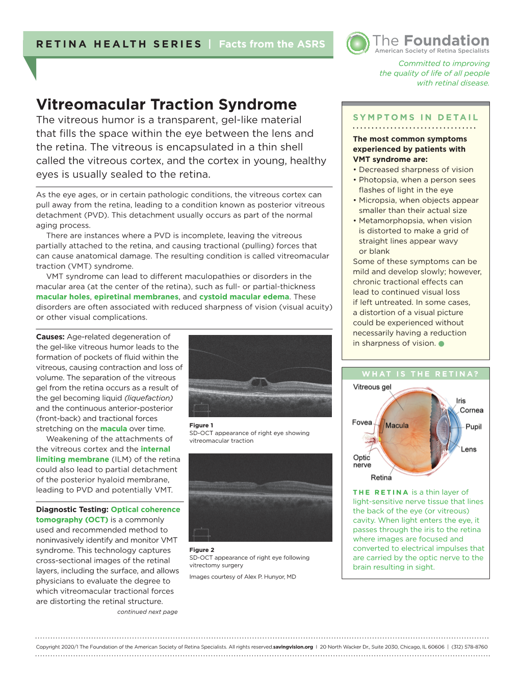 Vitreomacular Traction Syndrome