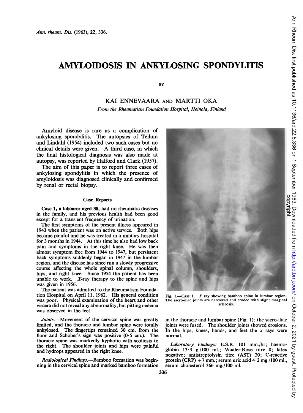Amyloidosis in Ankylosing Spondylitis