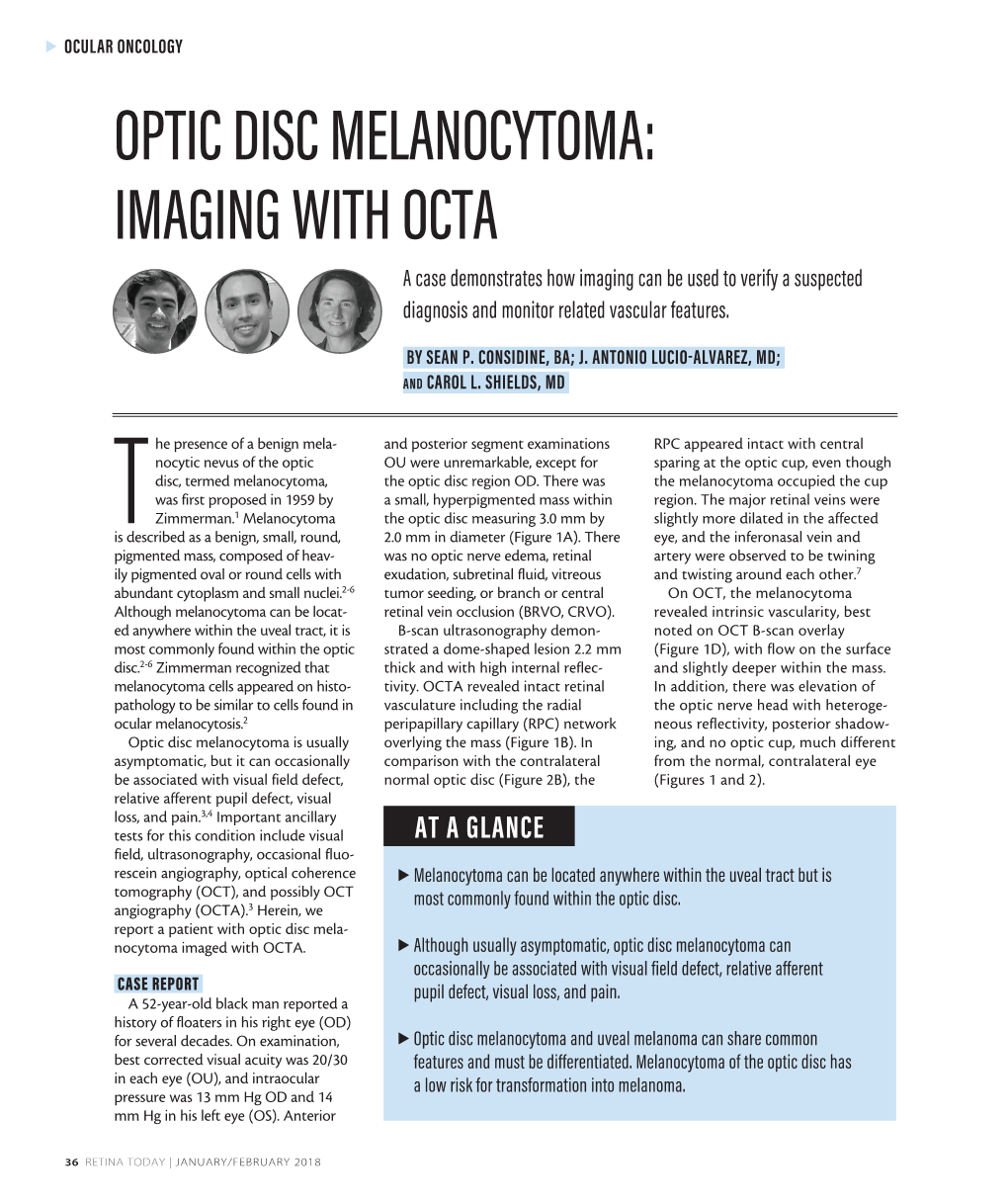 Optic Disc Melanocytoma: Imaging with Octa