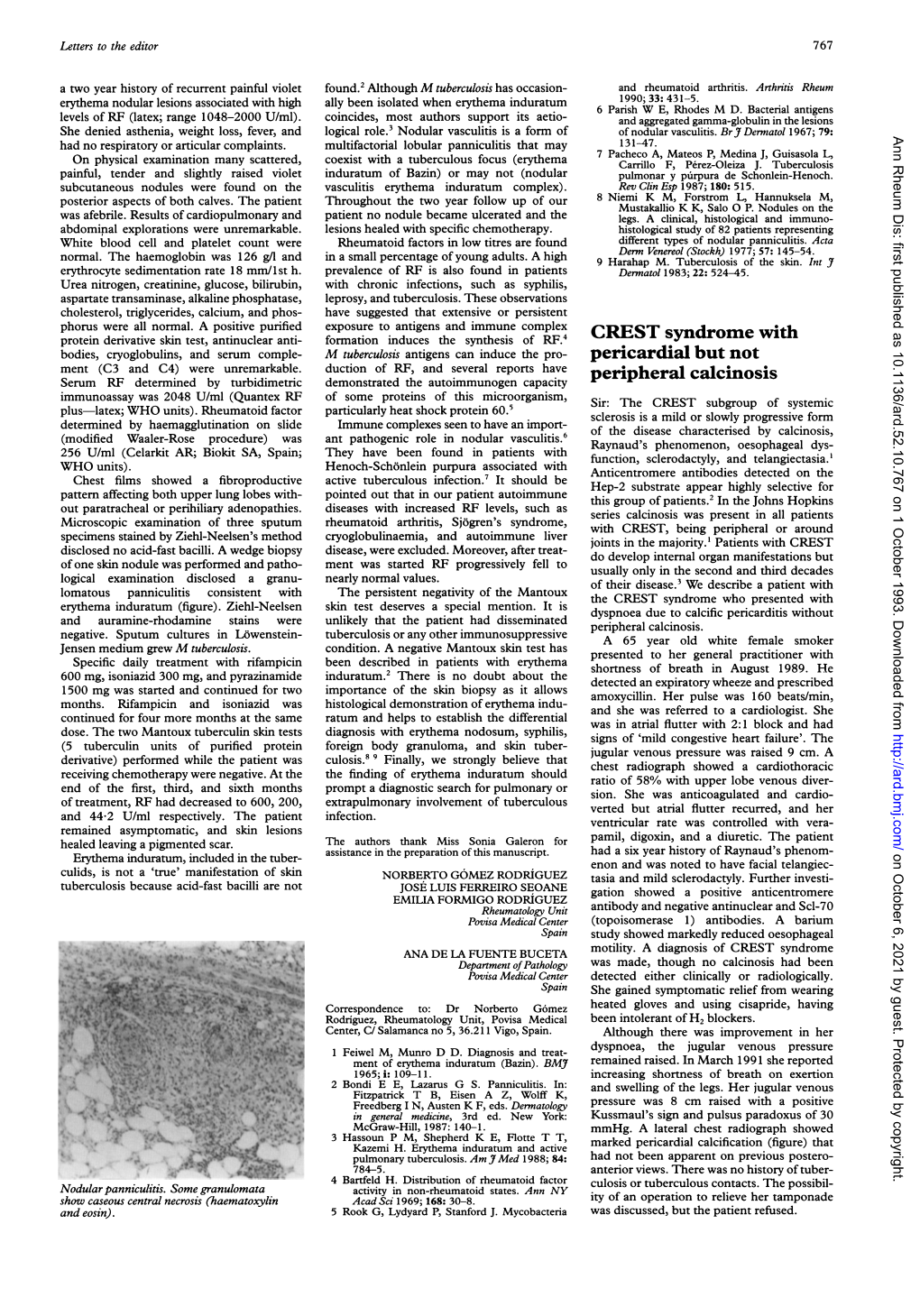 CREST Syndrome with Pericardial but Not Peripheral Calcinosis