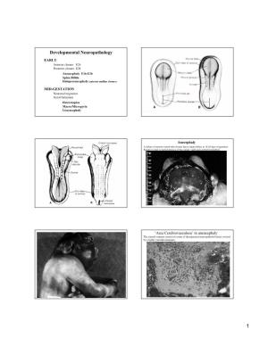 Developmental Neuropathology EARLY Anterior Closure E26 Posterior Closure E28 Anencephaly E16-E26 Spina Bifida Holoprosencephaly (Anterior Midline Closure)