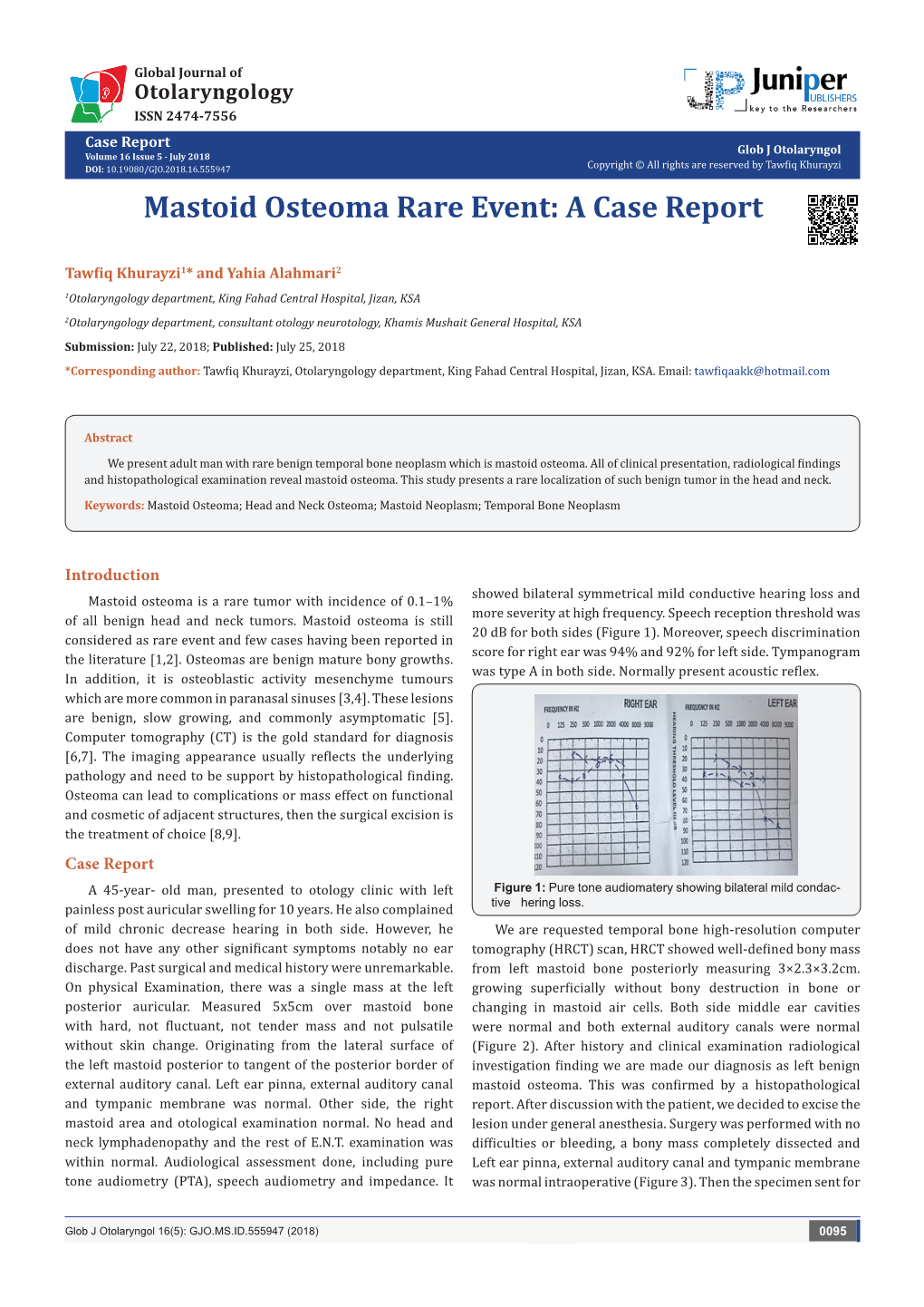 Mastoid Osteoma Rare Event: a Case Report