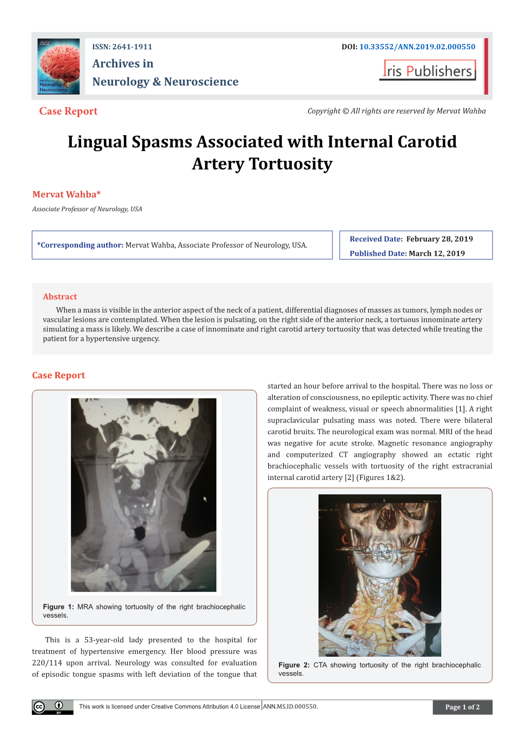 Lingual Spasms Associated with Internal Carotid Artery Tortuosity