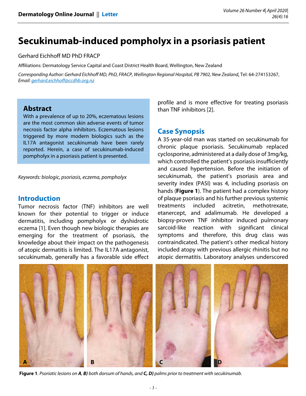 Secukinumab-Induced Pompholyx in a Psoriasis Patient