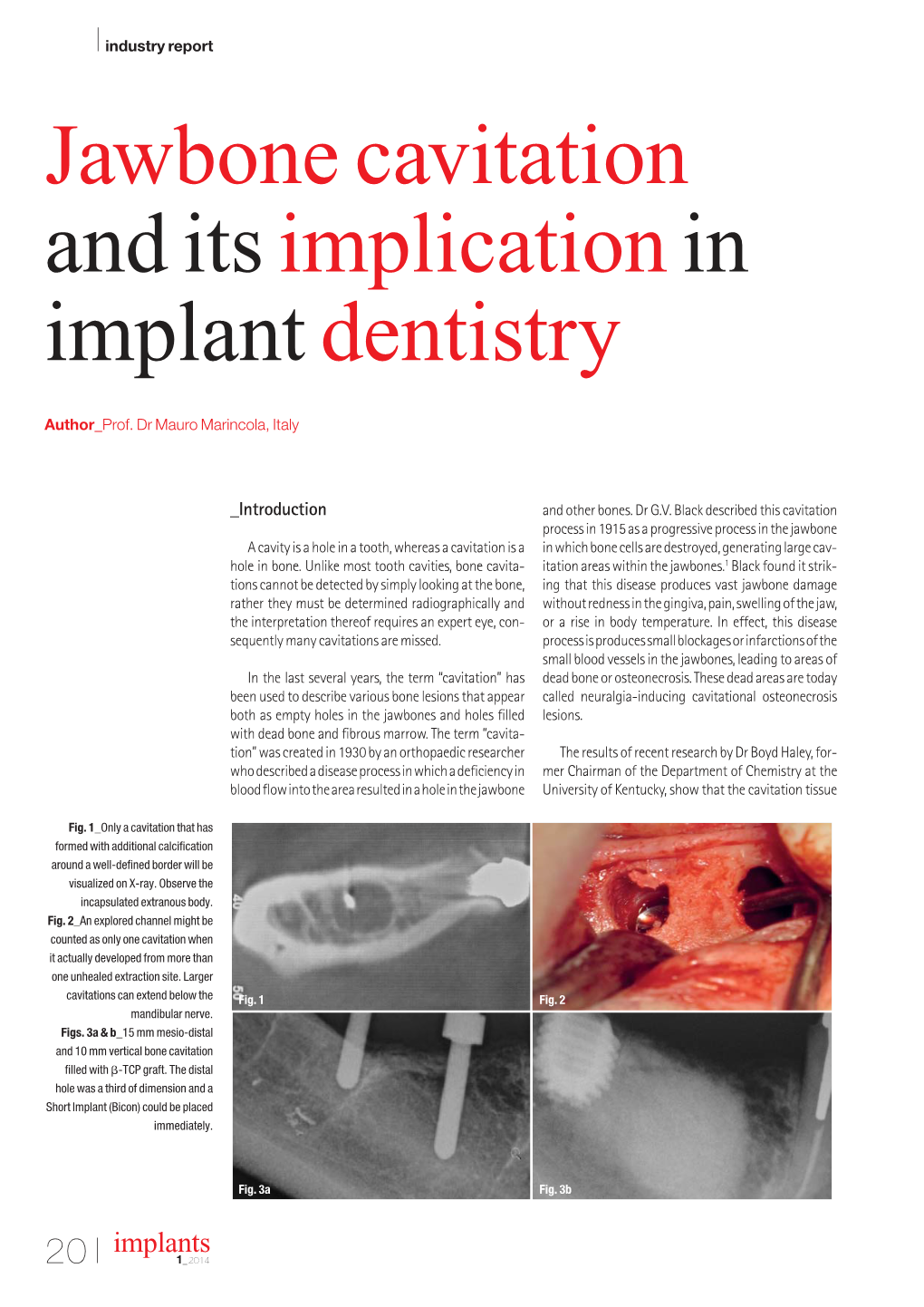 Jawbone Cavitation and Its Implication in Implant Dentistry