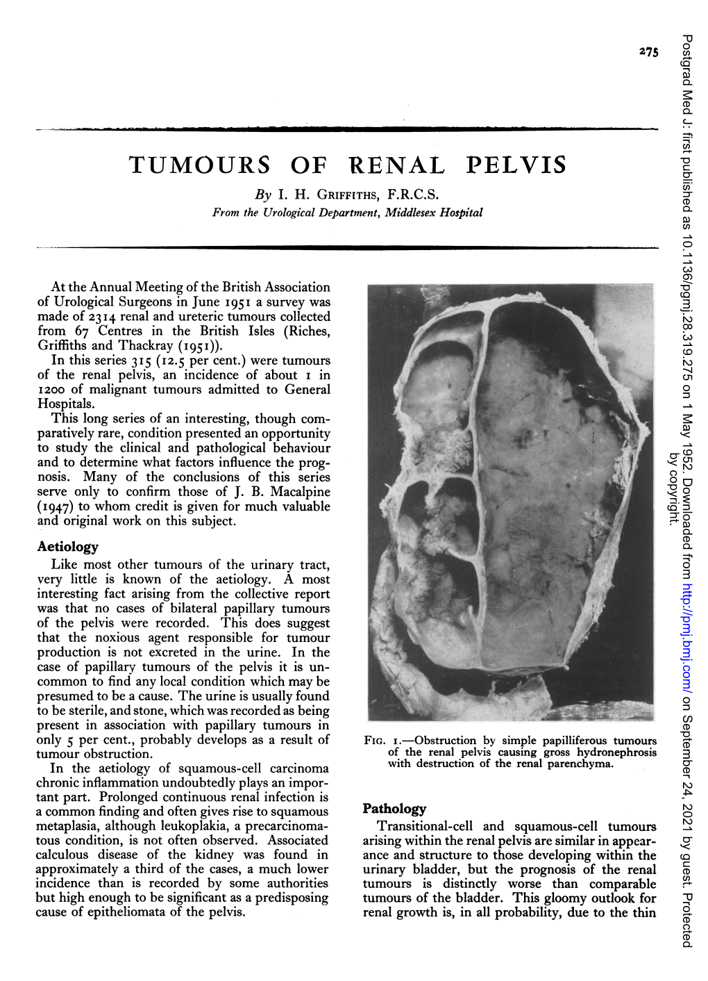 TUMOURS of RENAL PELVIS by I