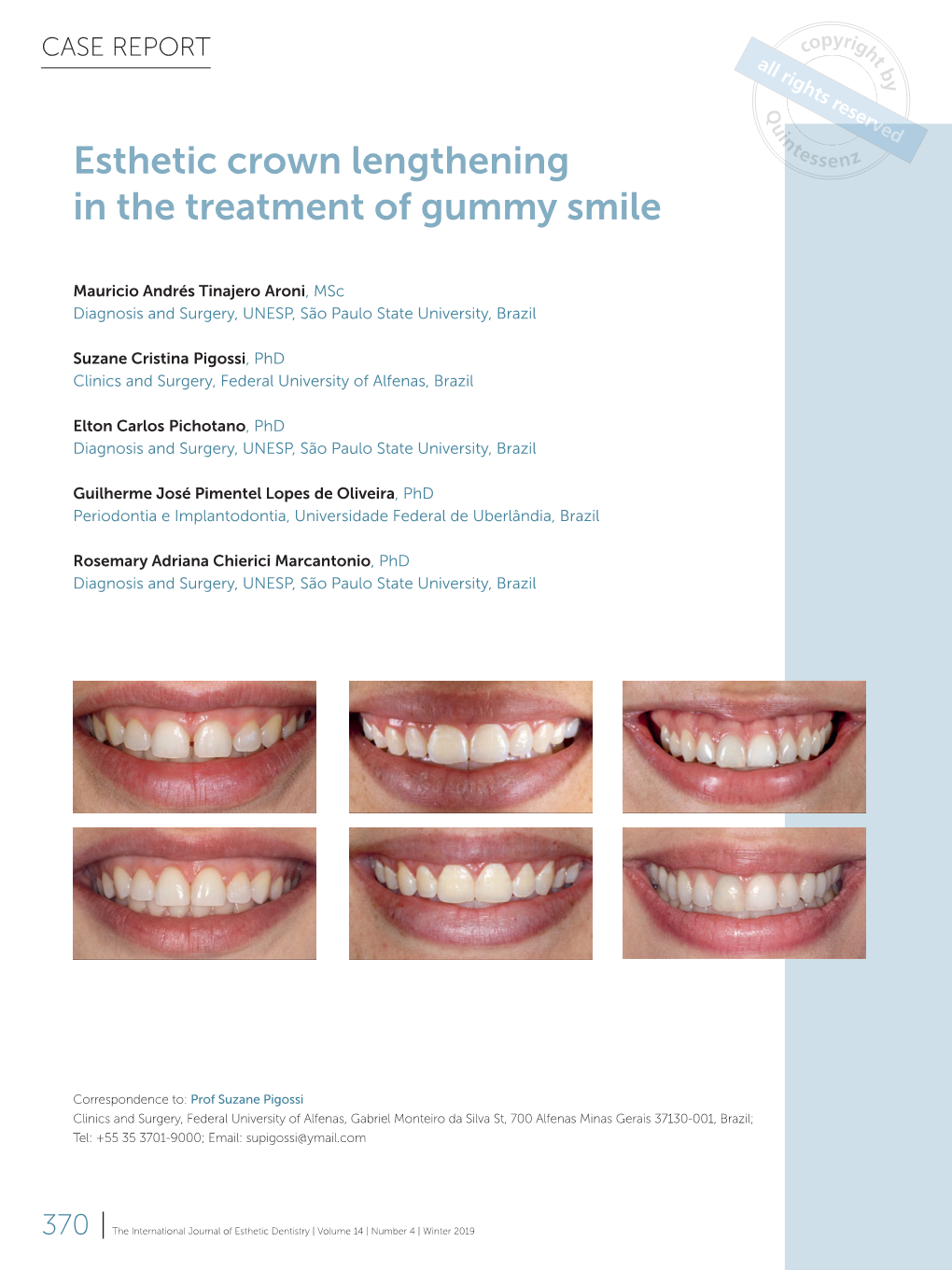 Esthetic Crown Lengthening in the Treatment of Gummy Smile