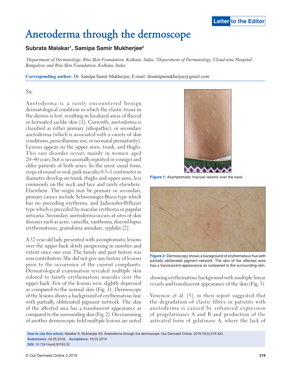 Anetoderma Through the Dermoscope