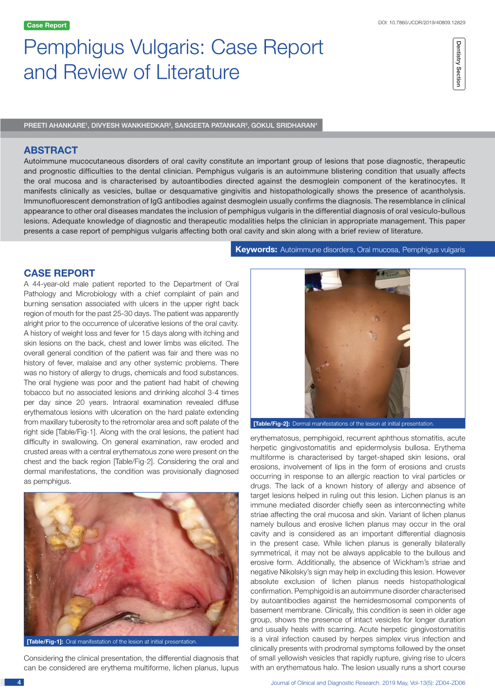 Pemphigus Vulgaris: Case Report Dentistry Section and Review of Literature