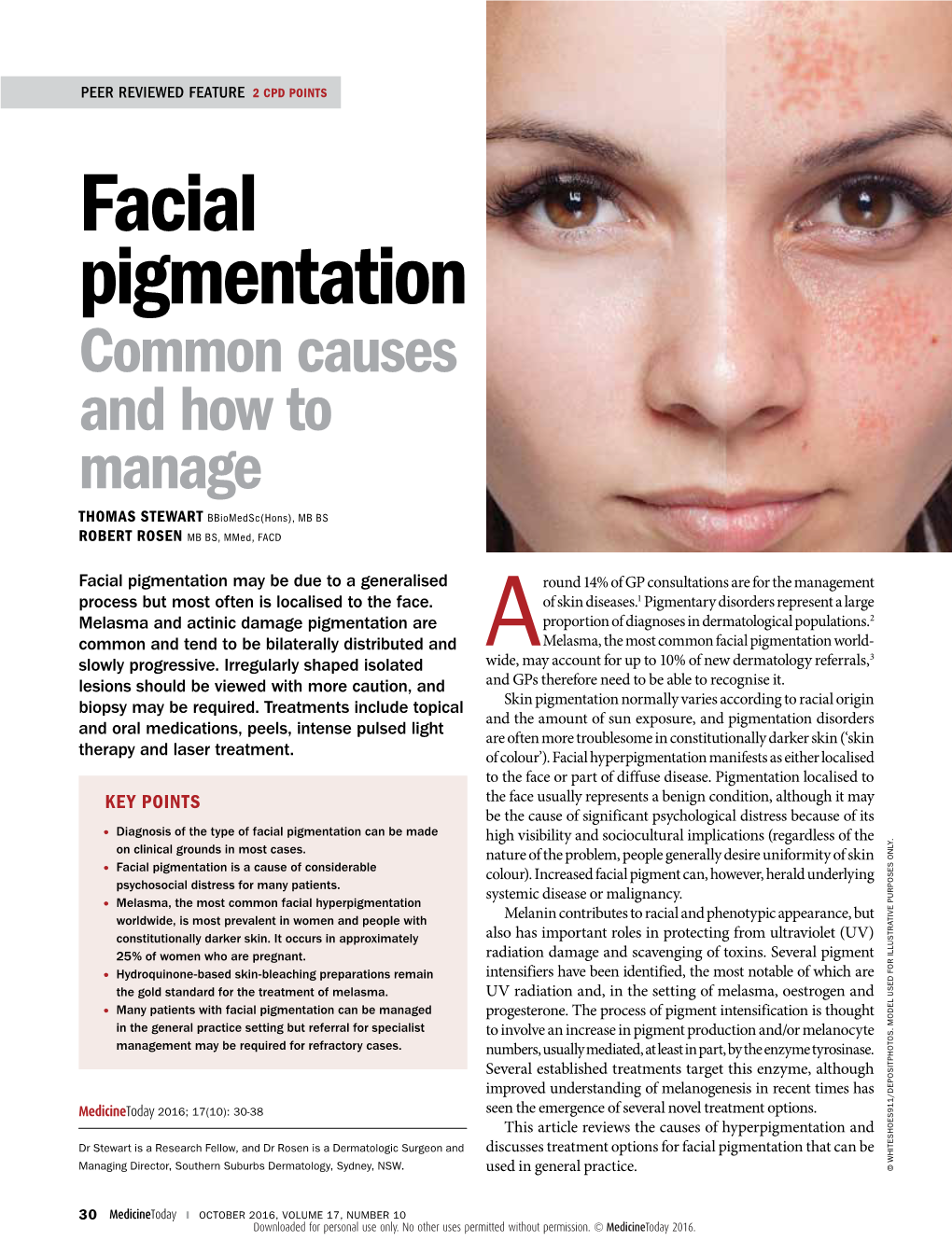 Facial Pigmentation Common Causes and How to Manage THOMAS STEWART Bbiomedsc(Hons), MB BS ROBERT ROSEN MB BS, Mmed, FACD