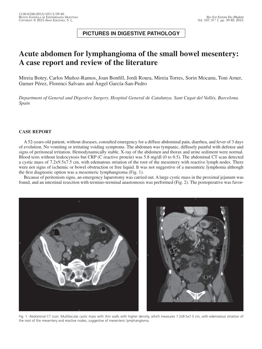 Acute Abdomen for Lymphangioma of the Small Bowel Mesentery: a Case Report and Review of the Literature