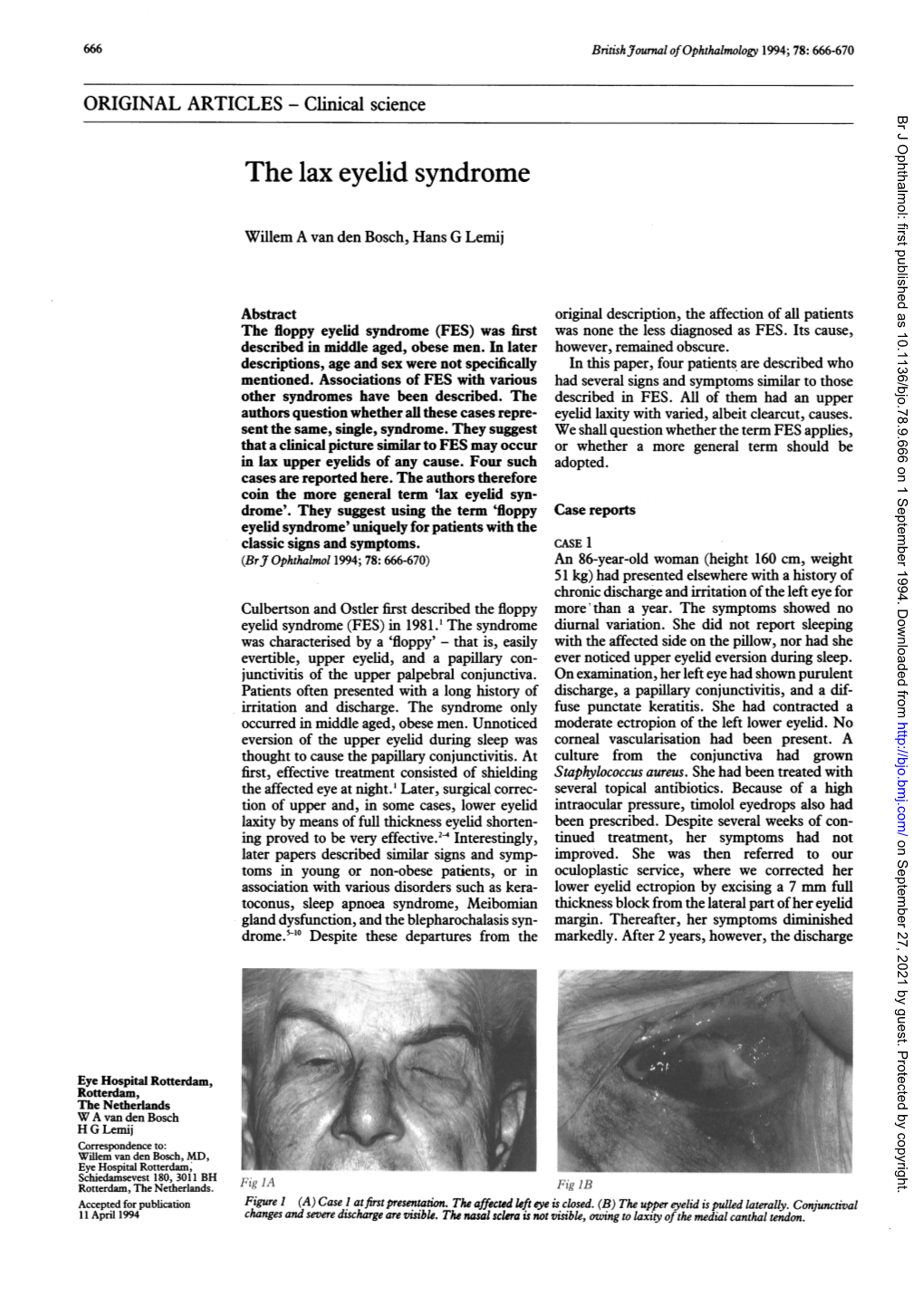 The Lax Eyelid Syndrome