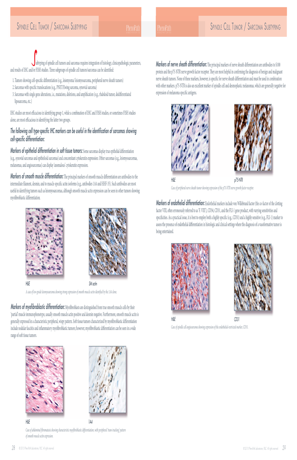 Spindle Cell Tumor