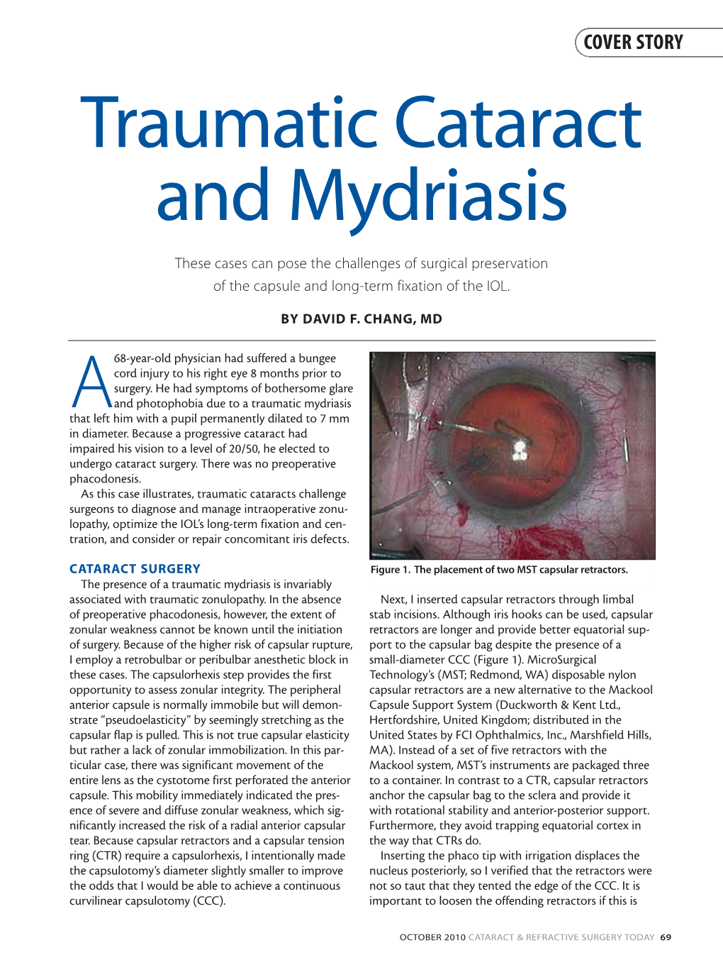 Traumatic Cataract and Mydriasis