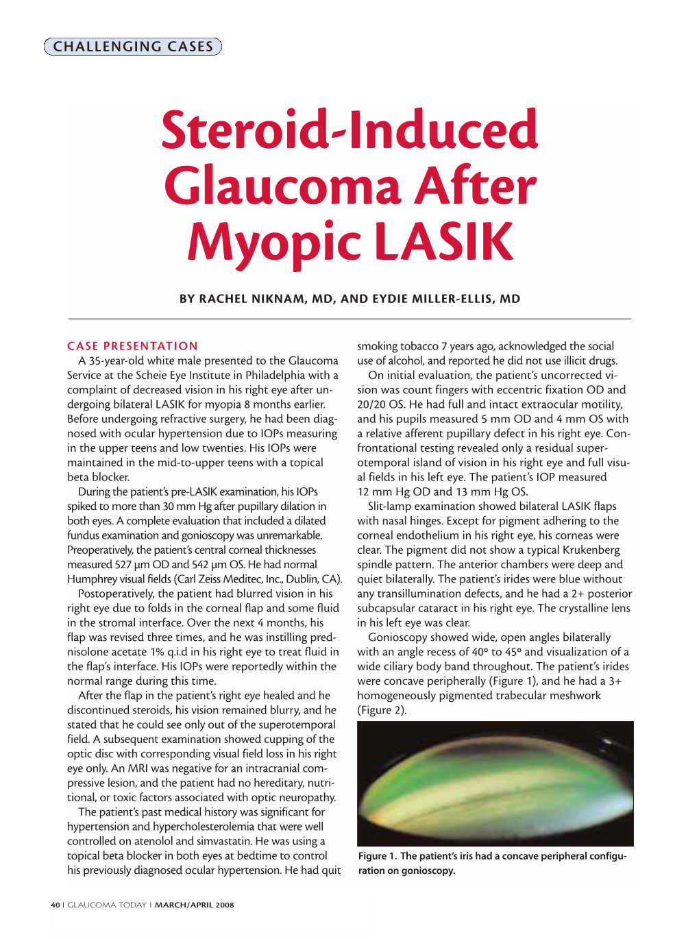 Steroid-Induced Glaucoma After Myopic LASIK
