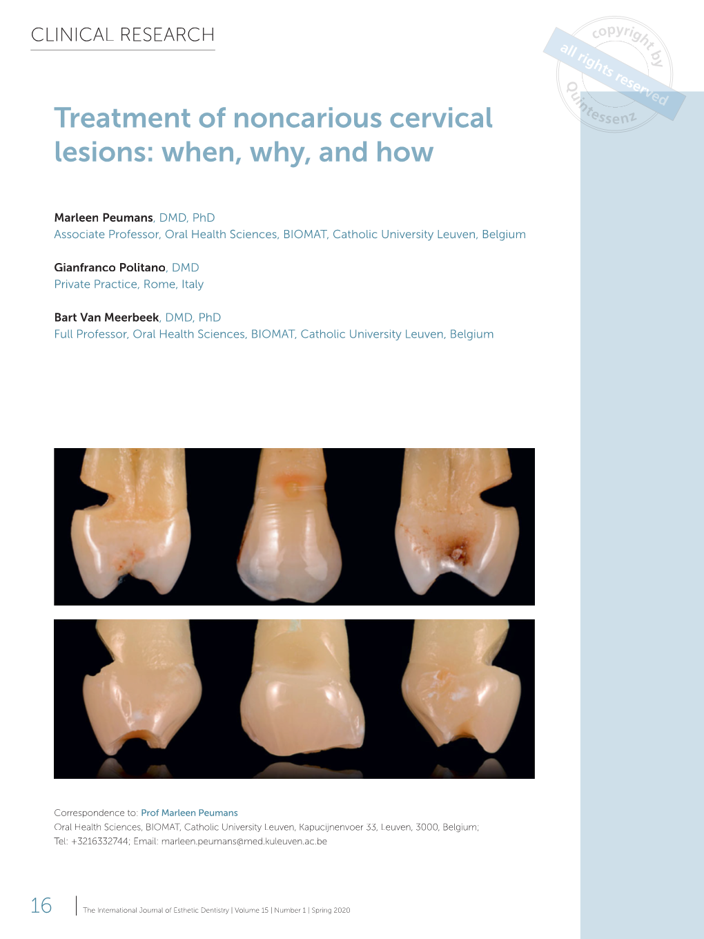 Treatment of Noncarious Cervical Lesions: When, Why, and How