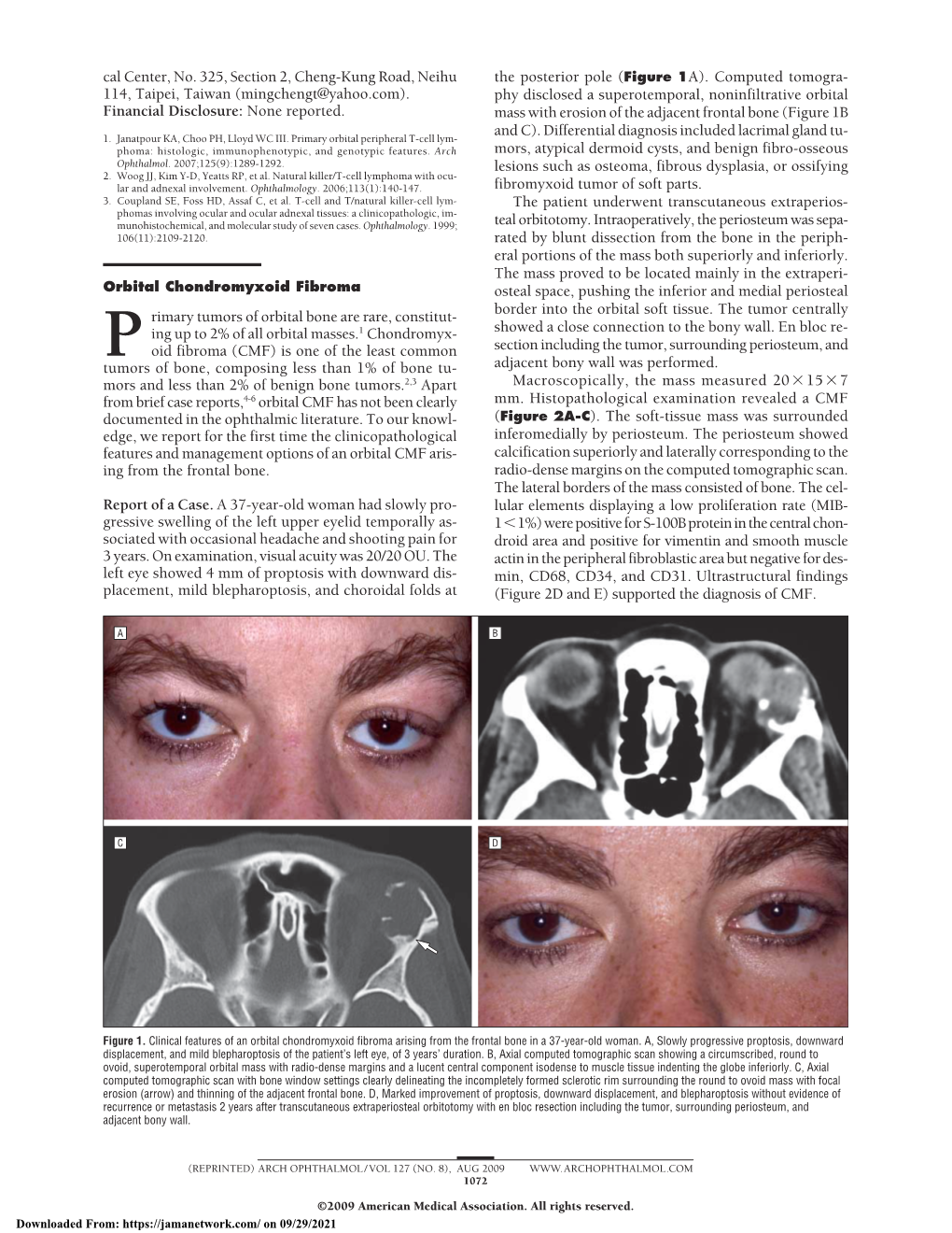 Orbital Chondromyxoid Fibroma Osteal Space, Pushing the Inferior and Medial Periosteal Border Into the Orbital Soft Tissue