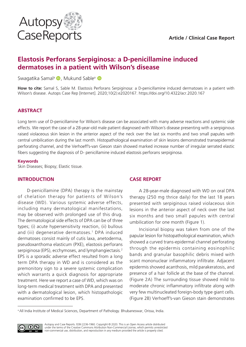 Elastosis Perforans Serpiginosa: a D-Penicillamine Induced Dermatoses in a Patient with Wilson’S Disease