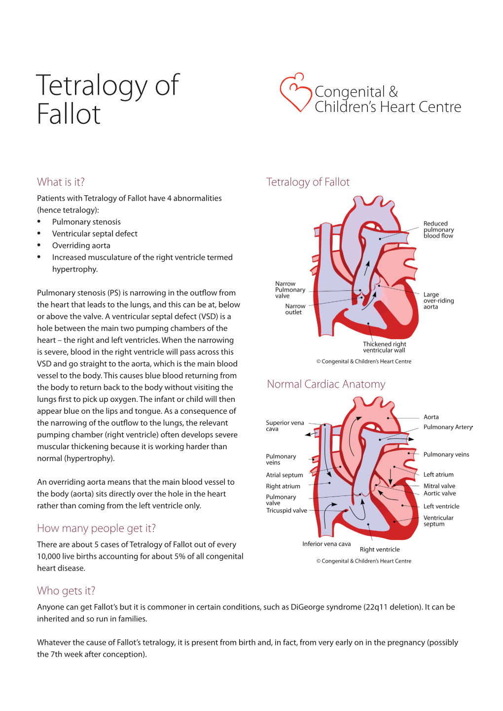 Tetralogy of Fallot