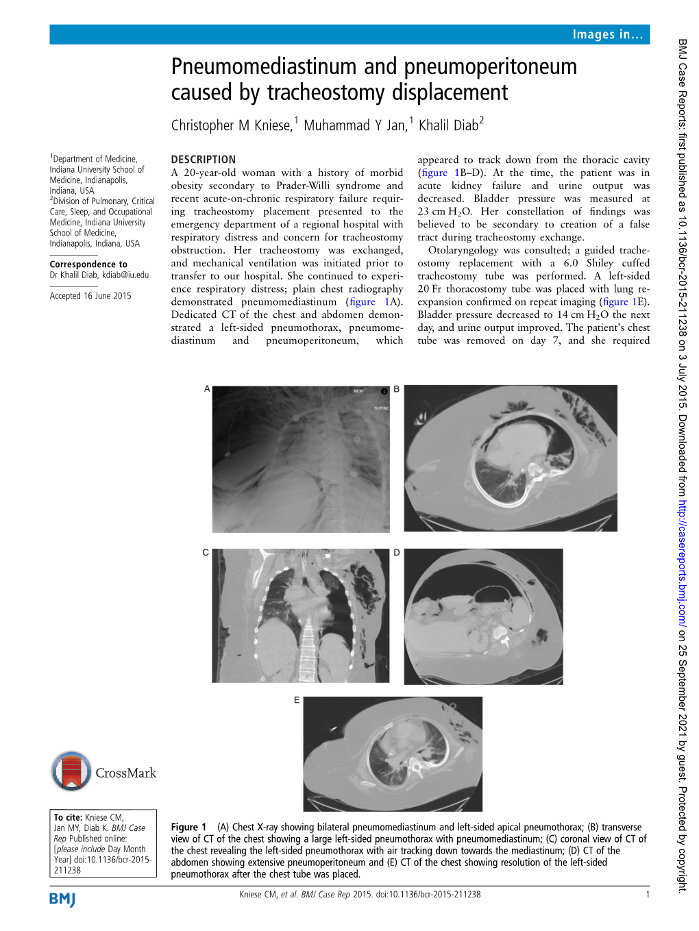 Pneumomediastinum and Pneumoperitoneum Caused by Tracheostomy Displacement Christopher M Kniese,1 Muhammad Y Jan,1 Khalil Diab2