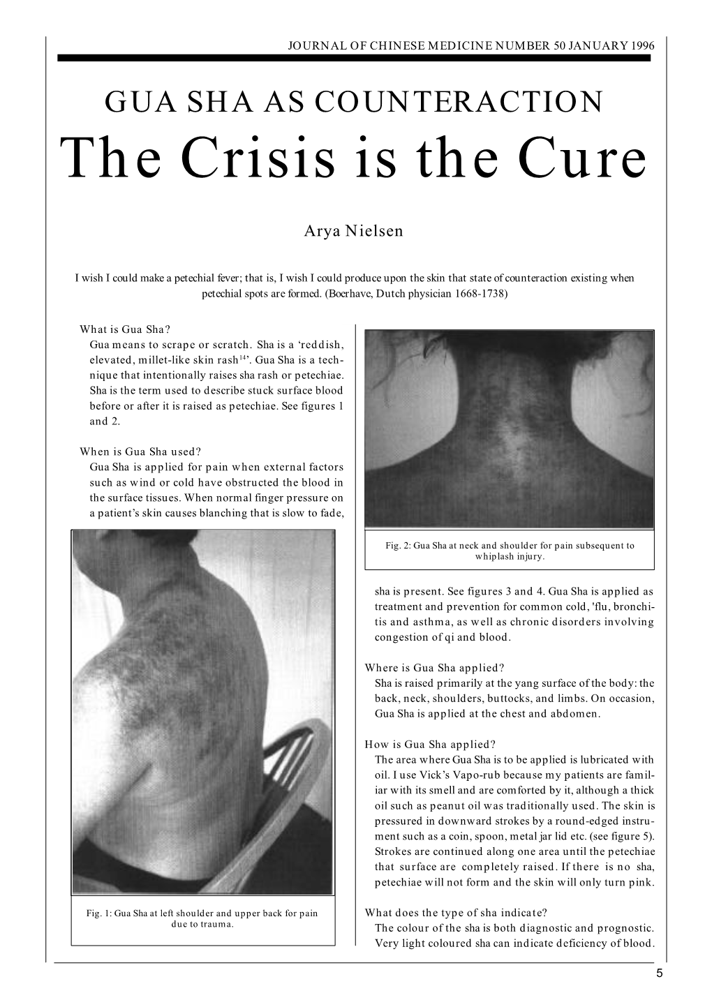 Gua Sha As Counteraction: the Crisis Is the Cure