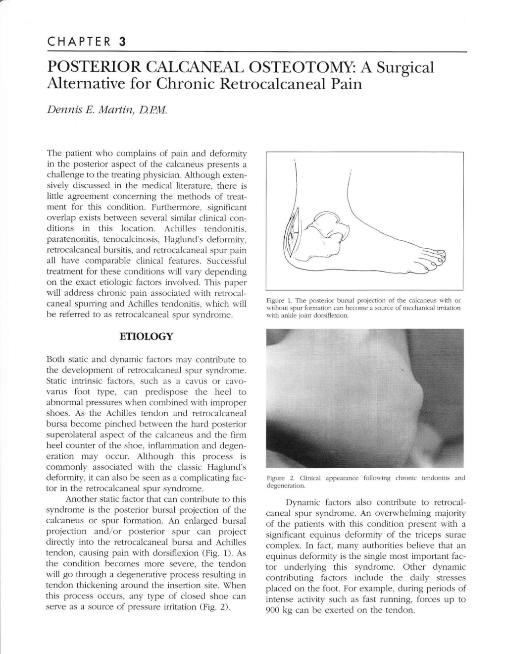 POSTERIOR CALCANEAL OSTEOTOMY: a Surgical Alternative for Chronic Retrocalcaneal Pain