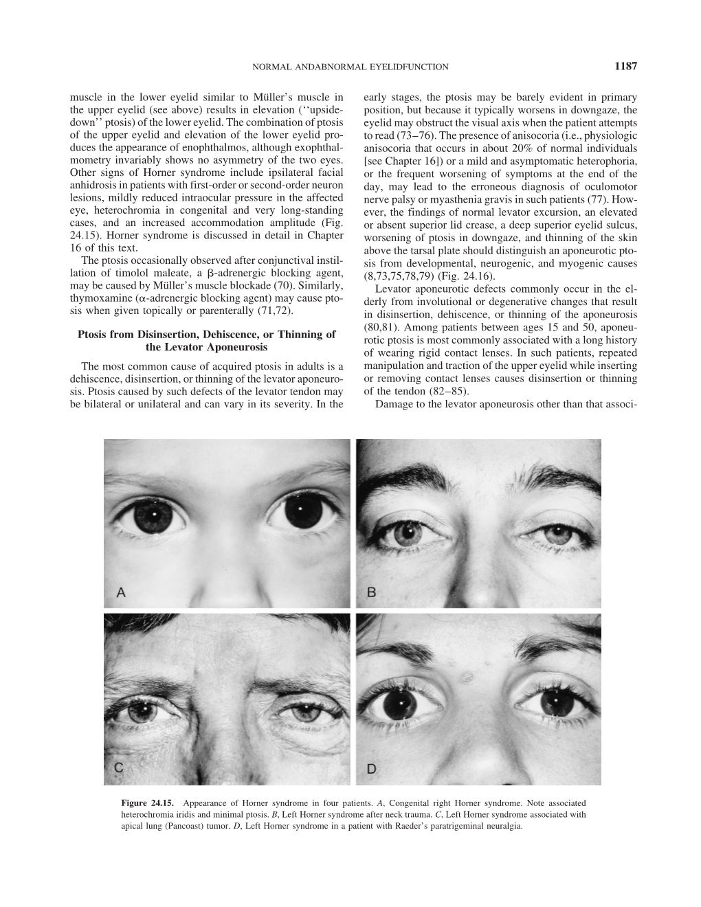 1187 Muscle in the Lower Eyelid Similar to Müller's Muscle in The