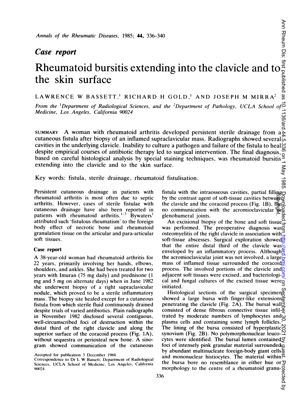 Rheumatoid Bursitis Extending Into the Clavicle and to the Skin Surface. Key Words: Fistula, Sterile Drainage, Rheumatoid Fistulisation
