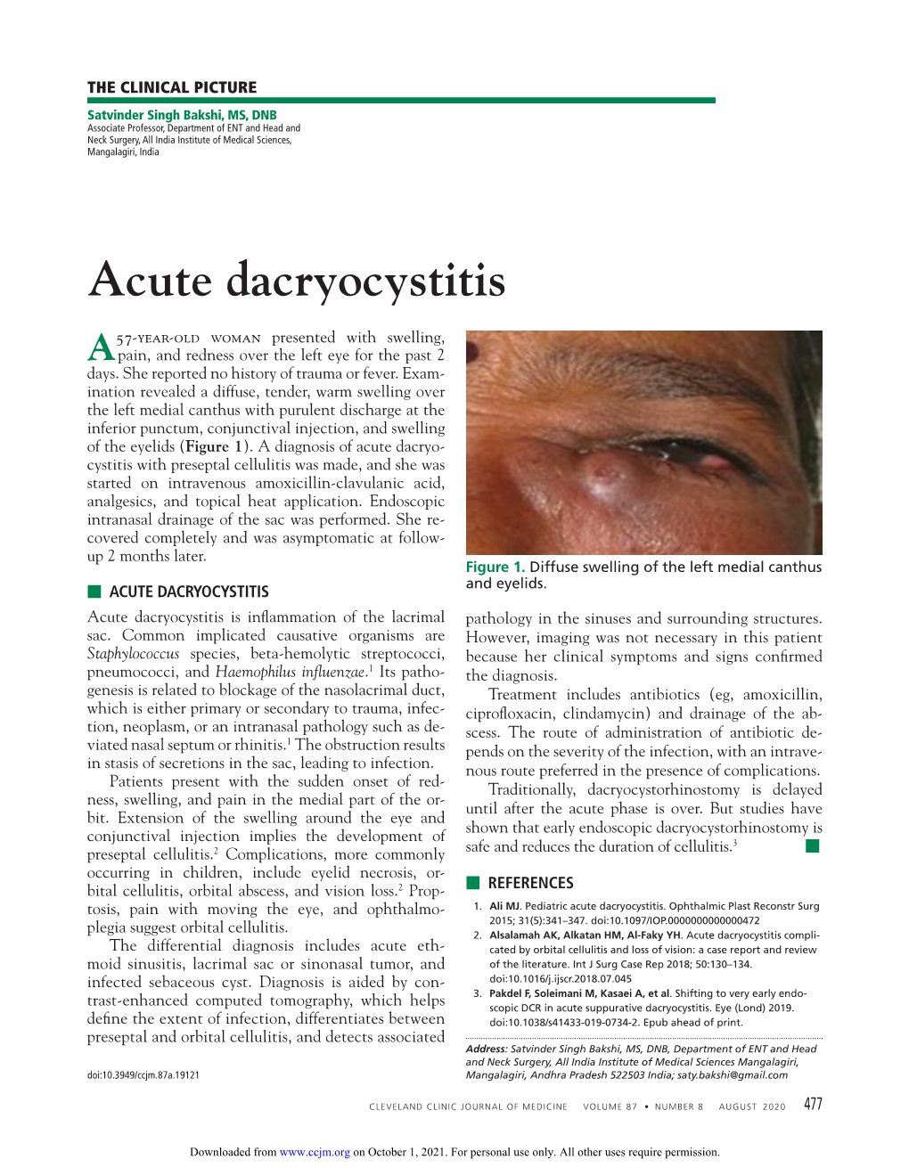 Acute Dacryocystitis