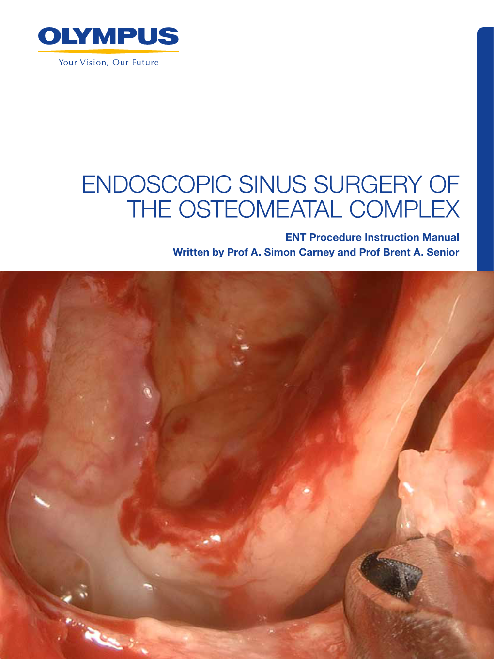 ENDOSCOPIC SINUS SURGERY of the OSTEOMEATAL COMPLEX ENT Procedure Instruction Manual Written by Prof A