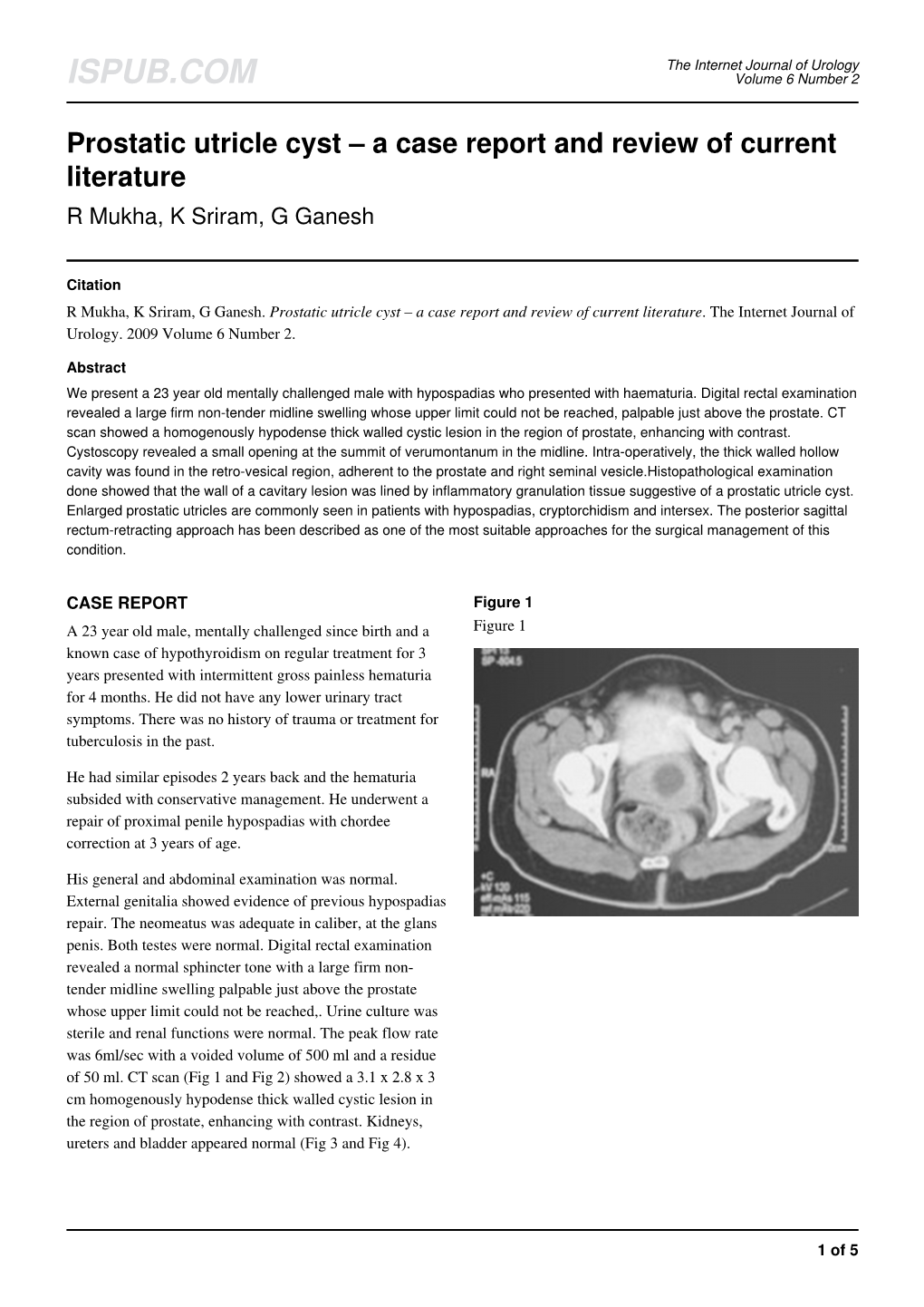 Prostatic Utricle Cyst – a Case Report and Review of Current Literature R Mukha, K Sriram, G Ganesh