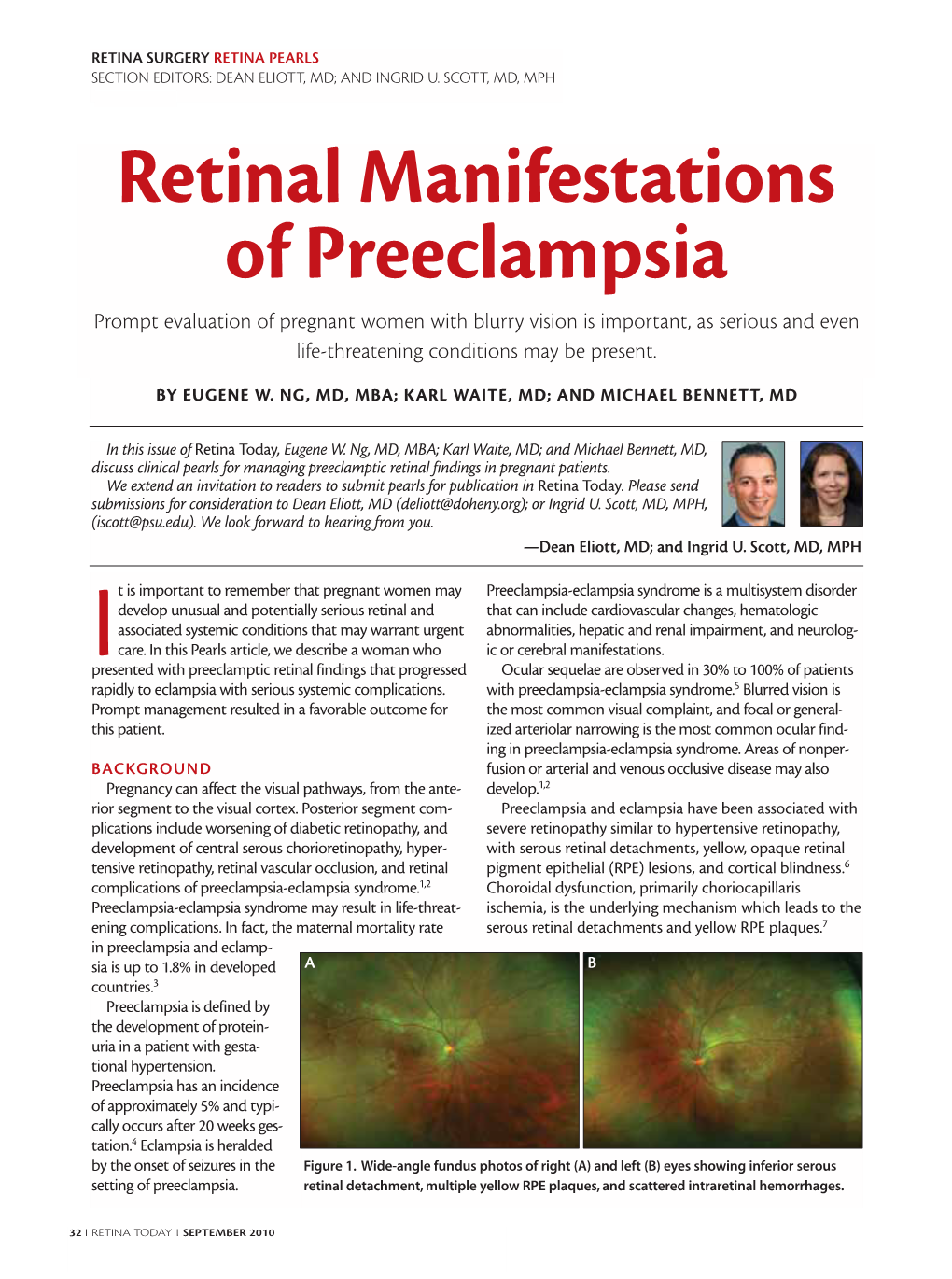 Retinal Manifestations of Preeclampsia