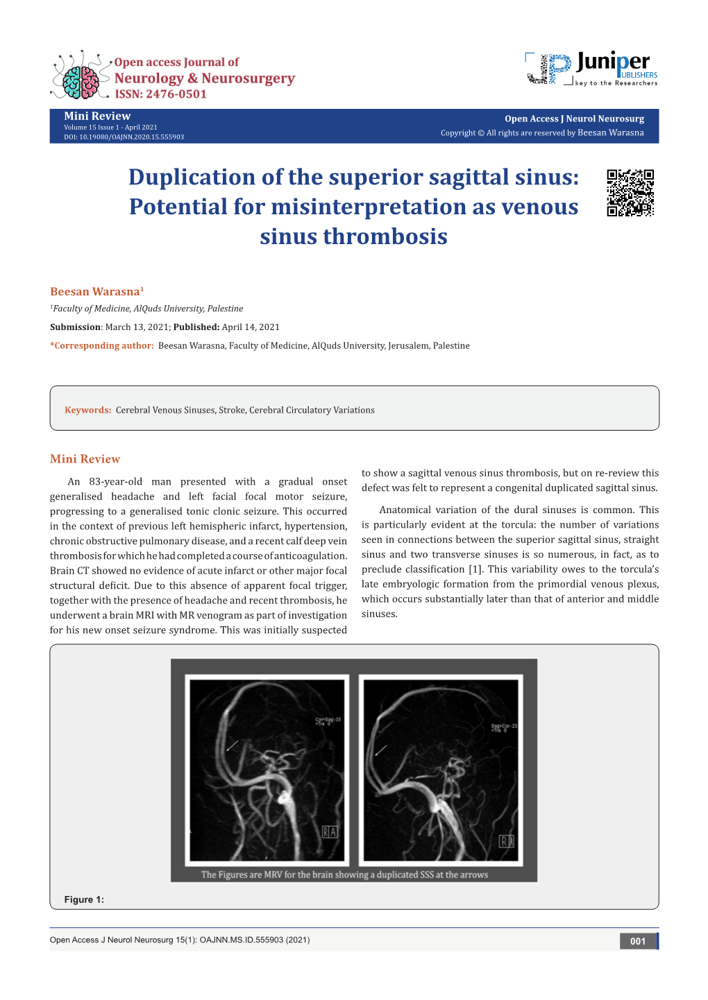 Duplication of the Superior Sagittal Sinus: Potential for Misinterpretation As Venous Sinus Thrombosis