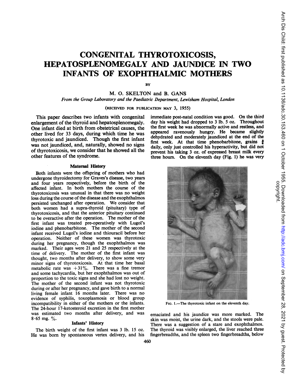 Congenital Thyrotoxicosis, Hepatosplenomegaly and Jaundice in Two Infants of Exophthalmic Mothers