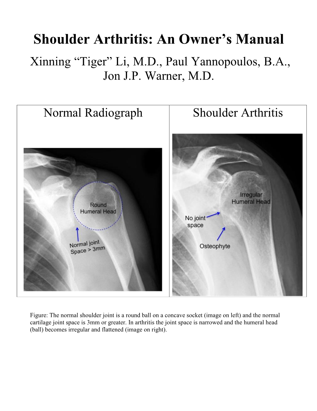 Shoulder Arthritis: an Owner's Manual