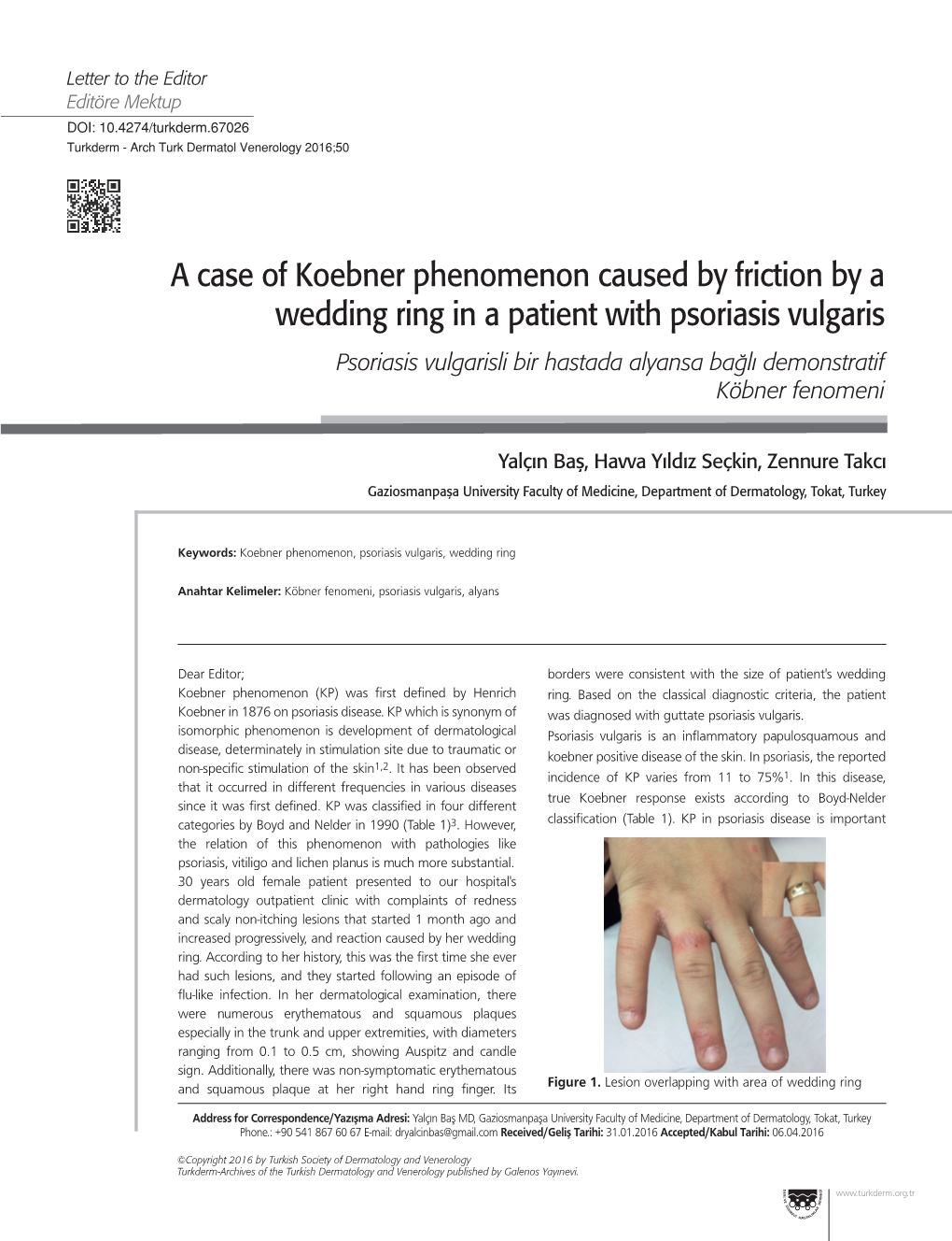 A Case of Koebner Phenomenon Caused by Friction by a Wedding Ring in a Patient with Psoriasis Vulgaris
