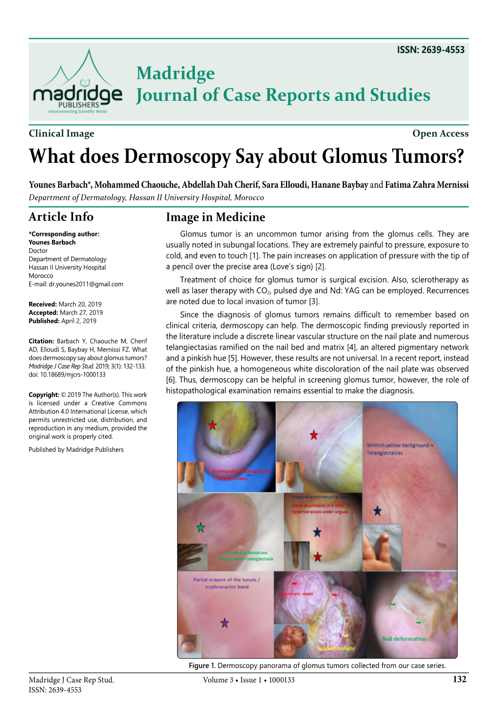 What Does Dermoscopy Say About Glomus Tumors?