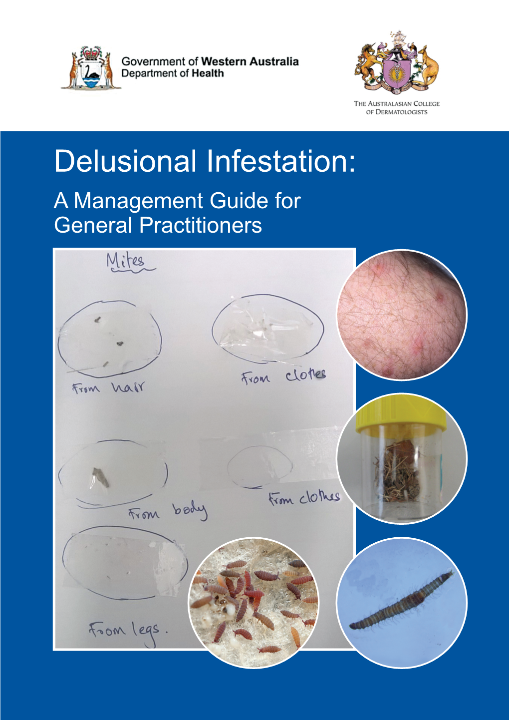 Delusional Infestation: a Management Guide for General Practitioners