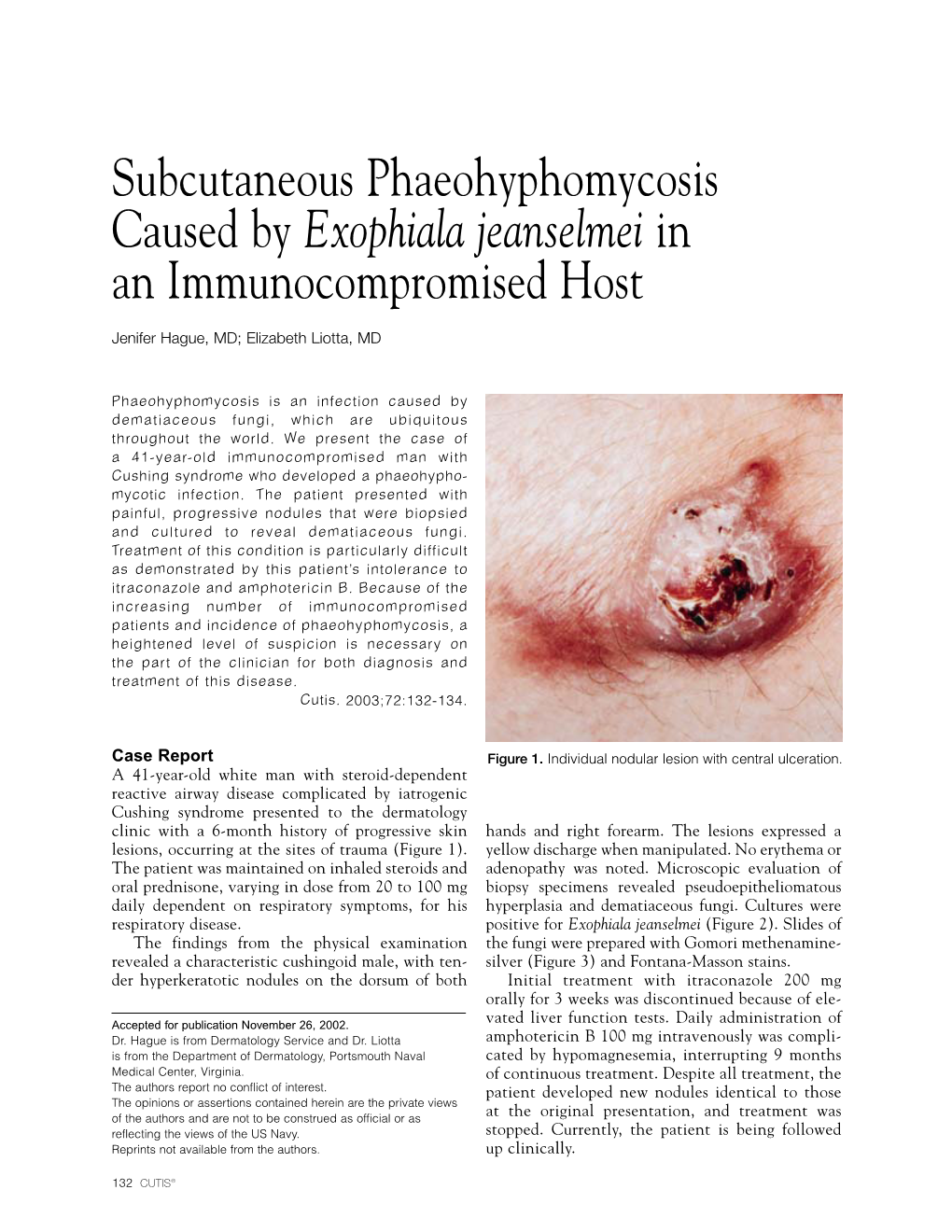 Subcutaneous Phaeohyphomycosis Caused by Exophiala Jeanselmei in an Immunocompromised Host