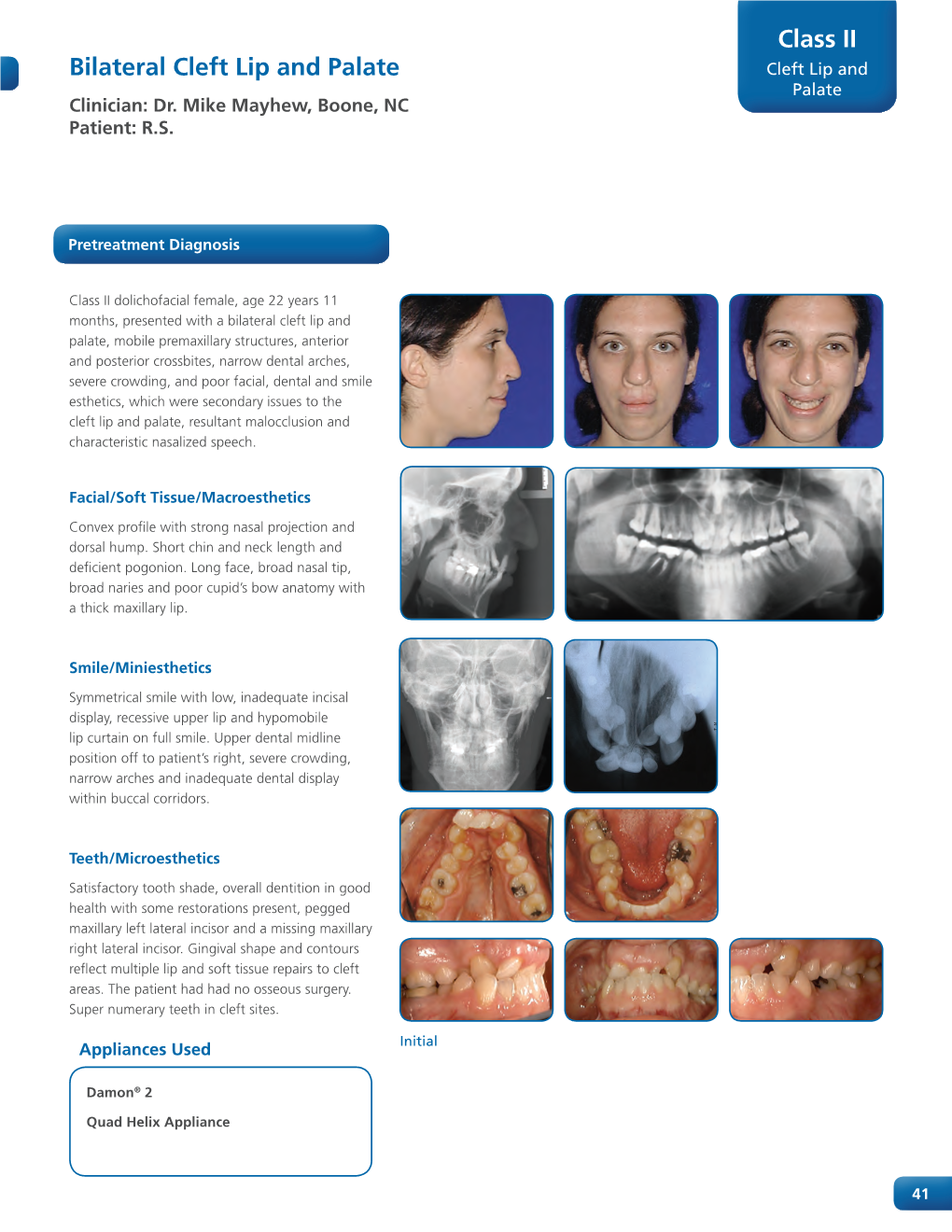 Bilateral Cleft Lip and Palate Class II